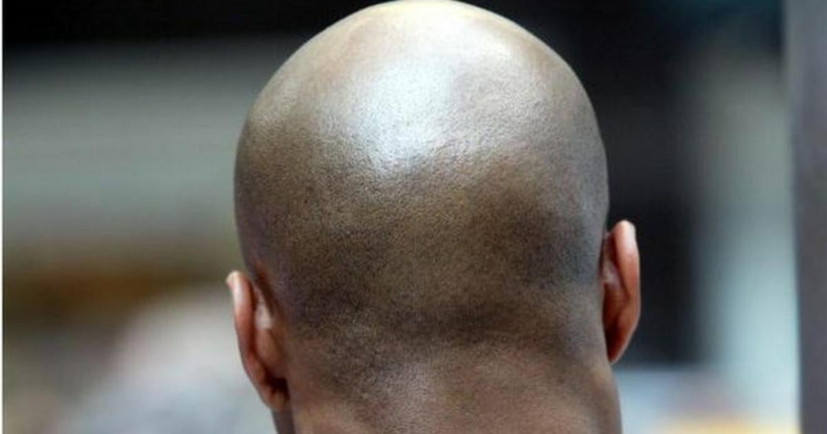 Aside from genetics, these are 12 things that can cause baldness