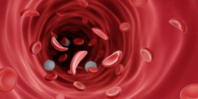 Sickle Cell Disorder And How It Concerns You (Part 2)
