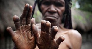 The women of this tribe cut off their fingers when a loved one dies