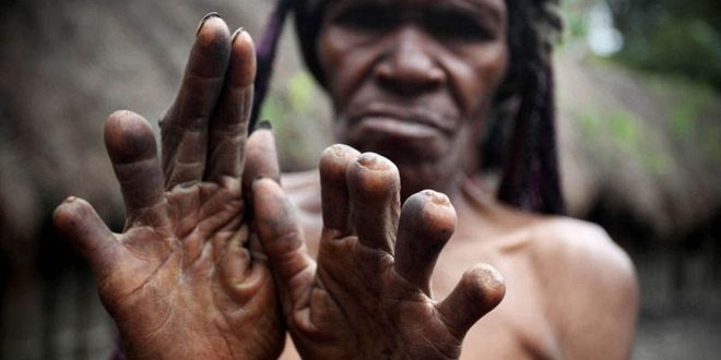 The women of this tribe cut off their fingers when a loved one dies