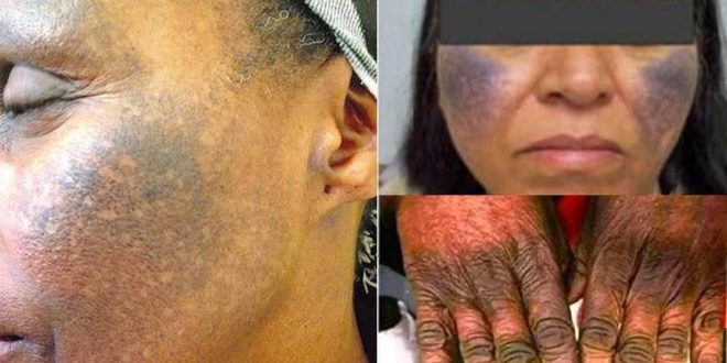 The dangers of using bleaching creams and how to repair the damage