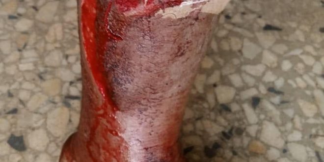 Woman set to divorce husband after he inflicted deep cut on her leg (graphic photos)