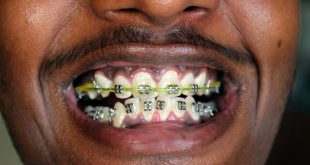 5 things you should know before you get braces