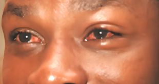 Causes, symptoms & how to prevent red eye disease