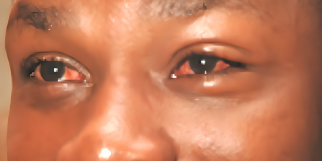 Causes, symptoms & how to prevent red eye disease