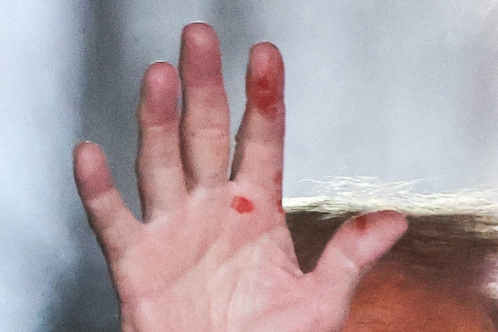 Mysterious red marks seen on Trump