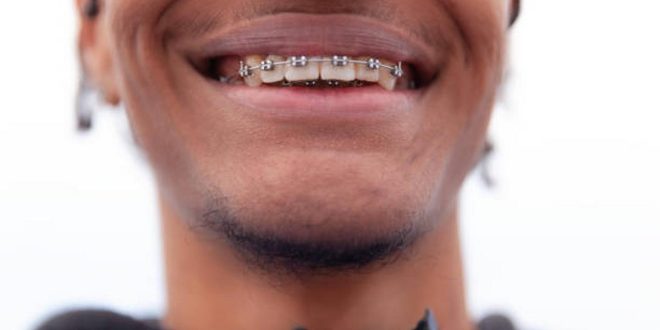 Braces-friendly menu: What to eat & what to avoid