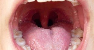 What To Know About Tonsillitis