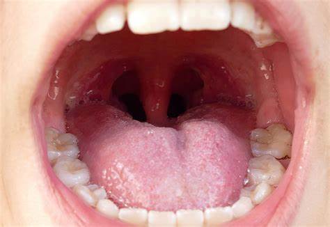 What To Know About Tonsillitis