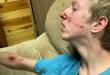 Bear mauls teen with rare disorder as he watched TV in cabin
