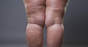 Cellulite: Here's what they are and how to get rid of them
