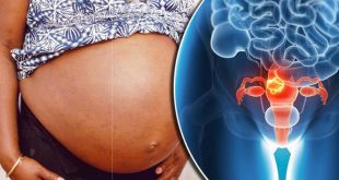 Can you have children after fibroid surgery? Here's what you should know