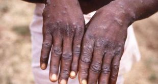The alarm bells sounds in East Africa over a Monkeypox (mpox) outbreak
