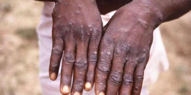 The alarm bells sounds in East Africa over a Monkeypox (mpox) outbreak