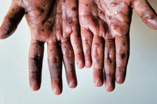 WHO prequalifies vaccine for monkeypox for the first time