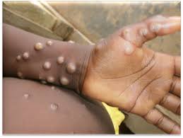 Within 6 months - WHO sets targets to end Mpox outbreaks in Africa