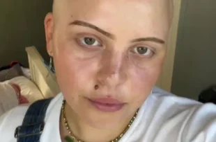 Young Woman says catching Covid eight times made her bald