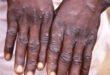 Ghana confirms first case of monkeypox in 2024