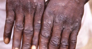 Ghana confirms first case of monkeypox in 2024