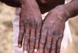 Sierra Leone reports first case of monkeypox