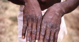 Sierra Leone reports first case of monkeypox